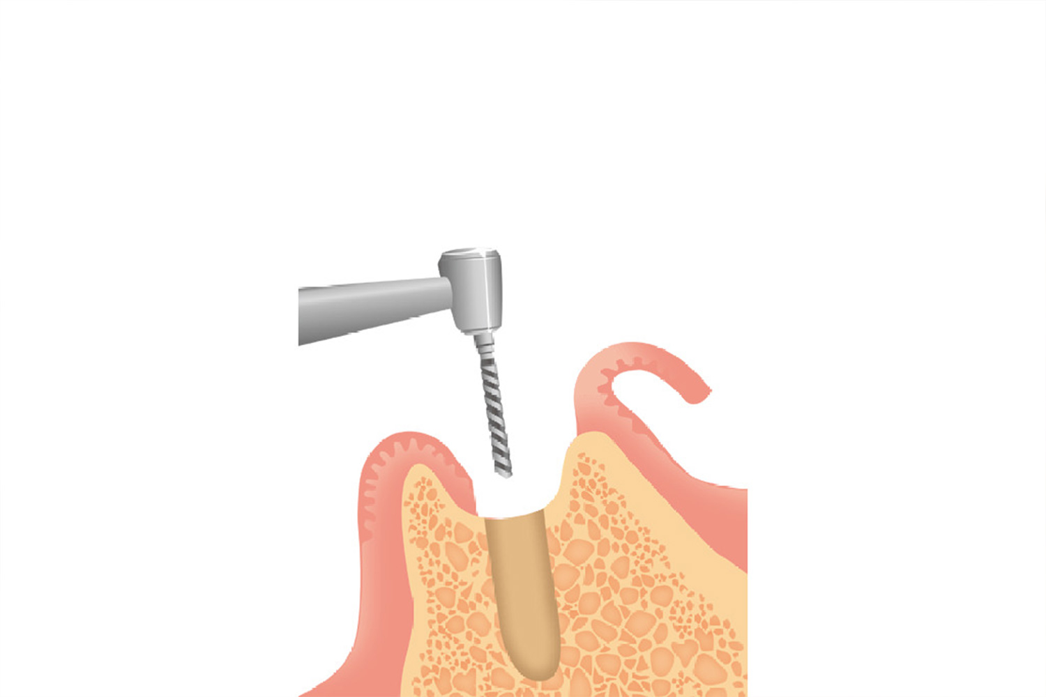 インプラント体の埋入