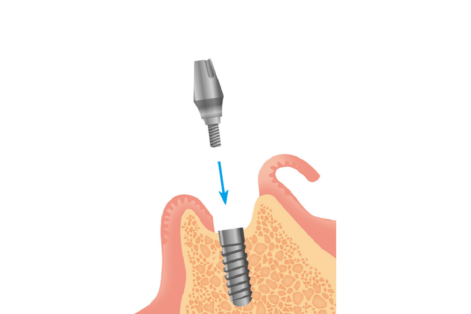 アバットメントの装着