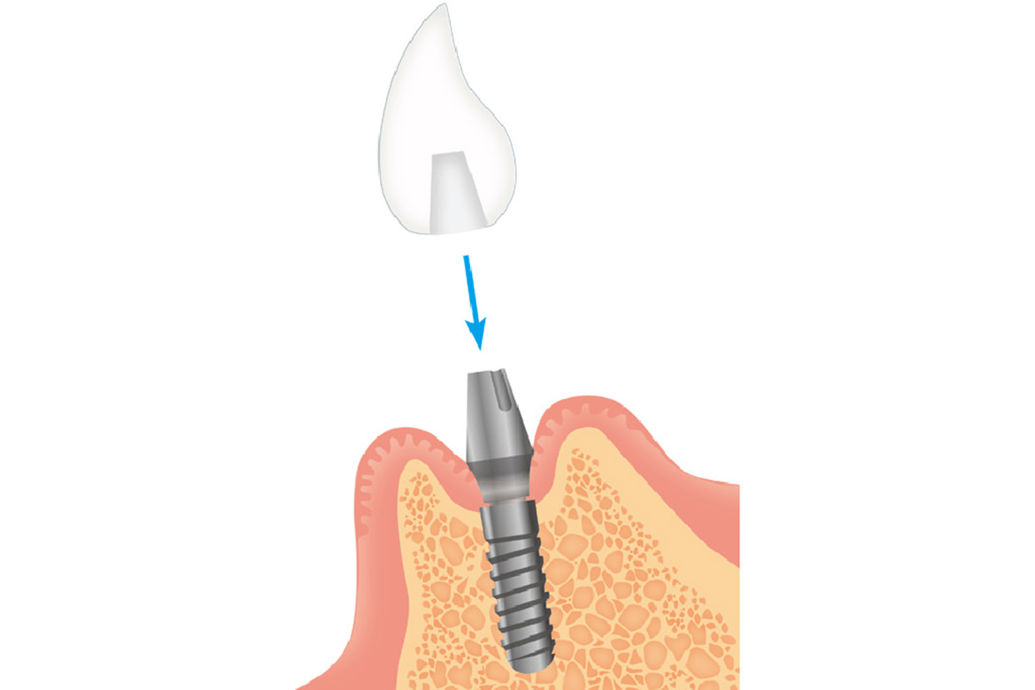 人工歯の型取り・仮歯の装着・人工歯の装着